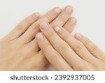 Small photo of Fingernails with onycholysis after removing gel polish on grey background. Womans hands with damaged nails