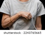 Small photo of Volkmann contracture in left upper limb of Southeast Asianold woman. It is a permanent shortening of forearm muscles that gives rise to a clawlike posture of the hand, fingers, and wrist.