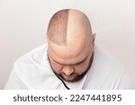 Small photo of male baldness before and after treatment. portrait of man with baldness problem at a hair transplant operation. Cosmetic surgery. the process of hair transplantation on the head.