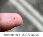 Small photo of Selective focused view of comedo or blackheads on a finger with blurred background. Macro photography.