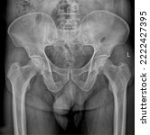 Small photo of Pelvis X-ray anteroposterior radiograph with left and right proximal femur