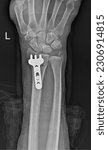 Small photo of Xray of a left forearm of a patient with fractured Distal radius bones after surgery with plate and screws fixation.