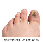 Small photo of Left foot with nail fungus thickened, discolored and ragged in the big toe and the second toe. Long nails and toe hair in white background. Macrophotograph with bright twin macro flash lights.