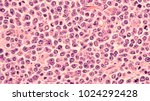 Small photo of Lymphoma awareness: photomicrograph of a diffuse large B-cell lymphoma (DLBCL) a type of non-Hodgkin lymphoma. This case is from the testis of an elderly man and shows prominent nucleoli.