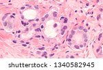Small photo of Prostate Cancer Awareness: Photomicrograph (microscopic image) of core biopsy of prostate gland showing histology of adenocarcinoma in patient with elevated PSA.