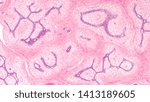 Small photo of Breast Biopsy: Microscopic image (photomicrograph) of a fibroadenoma, a benign circumscribed tumor composed of both glandular and stromal tissue.