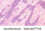 Small photo of Microscopic image (photomicrograph) of a poorly differentiated gastric mucinous adenocarcinoma (stomach cancer), signet ring cell type, with metastasis to regional lymph node.