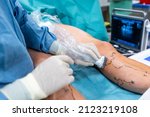 Small photo of Process of varicose vein surgery in hospital, operating room, vein sealing, venous vascular surgery concept