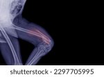 Small photo of X-ray image of the femur elderly patients accident showing distal fractures Express pain, blue tone, black background