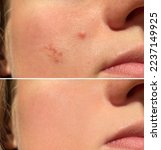 Small photo of check skin and acne closeup. Pimple before after