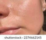 Small photo of Macro photo of big pore on oily facial skin type. Skin with enlarged pores. Care for problem skin. Sun, natural light