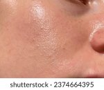 close-up girl with sweaty skin on her face and excessive oily sheen, excessive sweating, hyperhidrosis disease