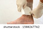 Small photo of Human skin disease. Human hands swathe with bandage, around scars, ulcers, peelings and age spots, possibly due to varicose veins or thrombosis on his leg. Close-up.