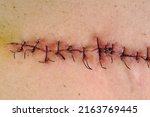 Medical sutures, stitches after surgery, stitched surgical sutures on human body. Medical surgical care. Close-up.