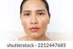 Small photo of Close up of women having skin problems on white background. W omen having damage skin burn after laser on her face