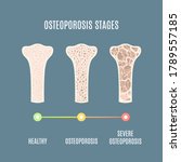Osteoporosis Process...