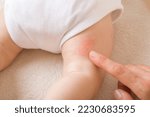 Young adult mother finger pointing to newborn leg with red rash. Allergy from milk formula or mother milk. Baby skin problem. Closeup. Top view.
