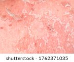 Small photo of texture of irritated reddened skin with flaking scales of dead old cells after sunburn and allergies on the human body