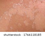 Small photo of skin texture with scales of dead cells and redness after sunburn come off the body