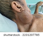 Small photo of Huge swelling at the side of neck representing Parotid Tumour.
