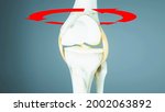 Knee Ligament Rupture  Cruciate ...