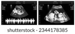 Small photo of pregnancy ultrasound film genecology sonogram, baby medical ultra scan diagnostic control