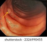 Small photo of A colon polyp found in the large intestine of a person with Lynch Syndrome during a colonoscopy.
