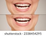 Small photo of close-up photo of female teeth before and after the installation of the bracket system. The concept of comparison. Dentistry and orthodontics. The result of bite correction.