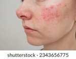Small photo of close-up profile of a young Caucasian woman suffering from the skin chronic disease rosacea on her face in the acute stage. Dermatological problems. isolated on a beige backgro
