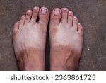 Small photo of Asian man foot tanned, tan feet, sandal marks, tanned body, black and white leg, due to slippers or flipflops in sunny day, half tan body and feet, tanning, sun burn, sunburned, foot illness, feets.