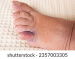 Small photo of close-up part of female foot, subcutaneous hemorrhage on little toe, concept of fracture, bruise, redness in area of injury, soft tissue edema, industrial or domestic injury
