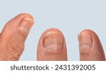 Small photo of injured finger, nail damage from impact, compression, tear, part of male finger injury close-up, bruise, industrial or domestic injury, suppuration