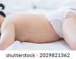 baby rash skin, prickly heat on baby (selective focus)	