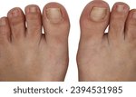 Small photo of Closeup inflammation of deform bunion joint in big toe bone. Hallux valgus, bunion in female foot compare with typical foot isolated on white background.