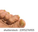 Small photo of Nail infections caused by fungi such as: onychomycosis also known as tinea unguium. Thumb infection. Caused by dermatophytes and yeasts and for the concomitant antibacterial activity