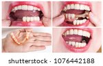 Small photo of Dental rehabilitation with lower flexible nylon denture, before and after treatment. Removable dentures flexible, devoid of nylon, hypoallergenic exempt from monomer