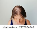 Hair loss in the form of alopecia areata. Bald head of a woman. Hair thinning after covid. Bald patches of total alopecia