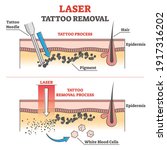 laser tattoo removal process... | Shutterstock .eps vector #1917316202