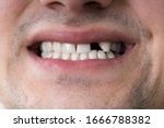 Close Up Photo Of Young Man With Missing Tooth
