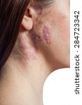 Small photo of Beautiful woman with real port-wine stain (birthmark) on her face, isolated on white background. converted from raw and edited with special care.