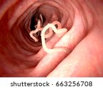 Tapeworm In Human Intestine. 3d ...