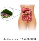gallstones in the gallbladder... | Shutterstock . vector #1157688838