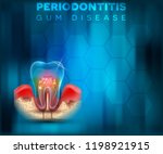 periodontitis gum disease... | Shutterstock .eps vector #1198921915