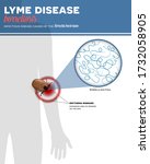 lyme borreliosis infection... | Shutterstock .eps vector #1732058905