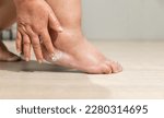 Small photo of Woman apply moisture lotion on edema (swelling) leg after cancer treatment. Broken heel.