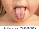 Small photo of Strawberry tongue of a small child with scarlet fever caused by group A streptococcus