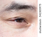 Small photo of Sore Red Eye. Chalazion and Blepharitis. Inflammation