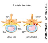 Spinal Disc Herniation. Back...