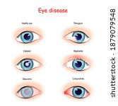 eye disease. comparison and... | Shutterstock .eps vector #1879079548