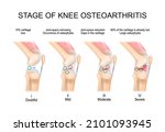 knee osteoarthritis. stages of... | Shutterstock .eps vector #2101093945